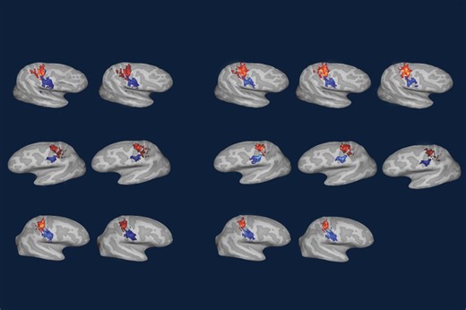 Adult human cortex does not reorganize after amputation