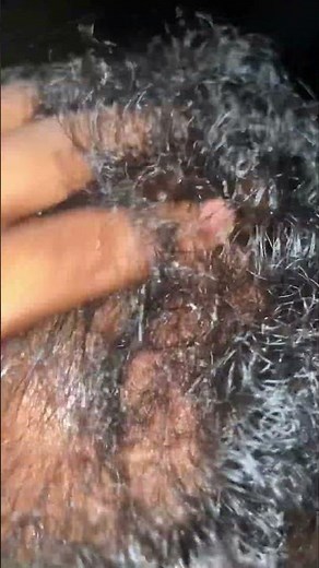 How to Use Minoxidil 5% Correctly for Hair Growth