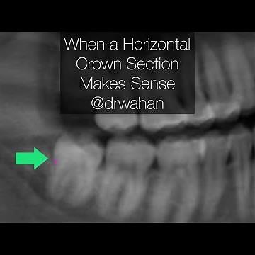 Step-by-Step Horizontal Crown Sectioning Removal of Mandibular Wisdom Tooth