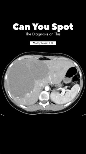 Giant Hepatic Hemangiomas on CT #shorts