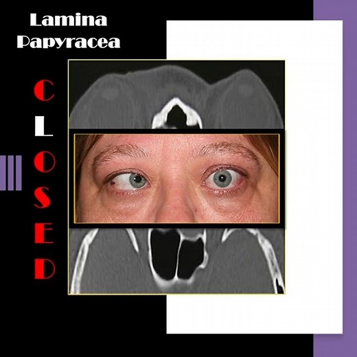 Nose radiology series (13); The lamina papyracea (9) #shorts