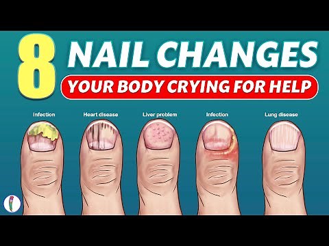 Nail signs of Disease | Nail pitting | Finger clubbing | Signs of anemia | Terry's nails