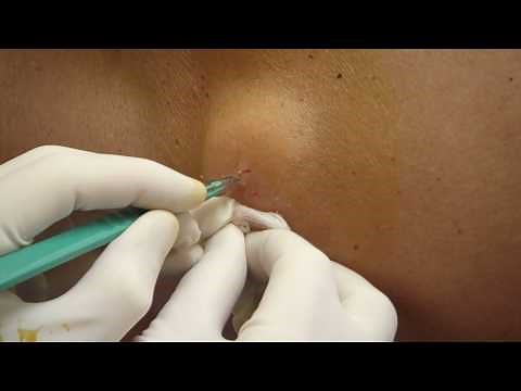 Huge Abscess on Back- Kent Rilling