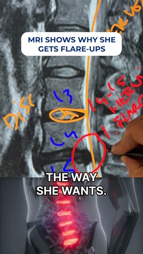 Skipped surgery: L4-L5 disc herniation improved by spinal decompression 46% #backpain #sciatica