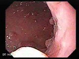 Gastric Polyposis - Endoscopy (4 of 11) • Video • MEDtube.net