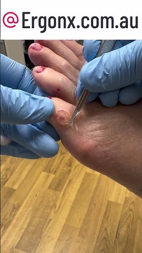 Expert Podiatrist Removes Corn & Callus from 5th Toe #FootCare #Podiatry
