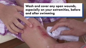 Everything beach-goers need to know about flesh-eating bacteria