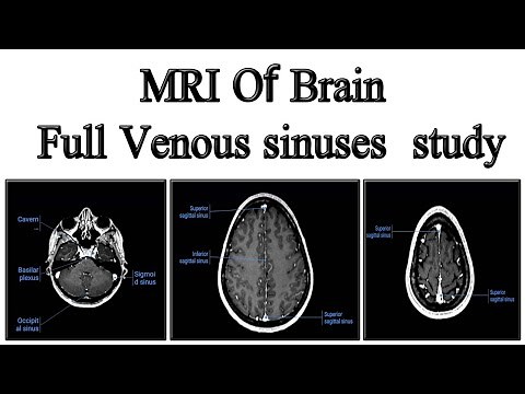 MRI Of Brain Venous sinuses study