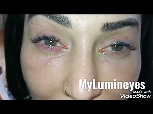 Eye Color Change Surgery Turkey Permanently