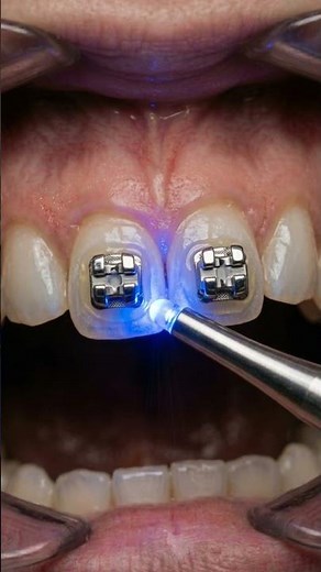 Braces Only Work with Perfect Bracket Placement 🦷 Here’s Why | #toothcraft #braces #shorts