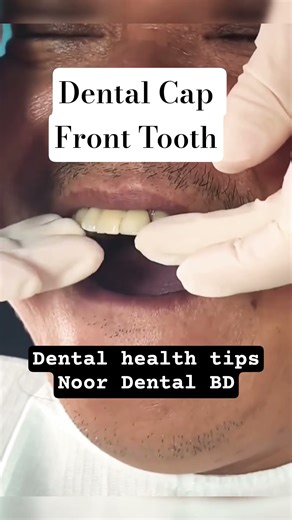 Front Tooth Dental cap@DentalHealthTips