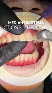 Close Teeth Gaps With Dental Filling: Simple Fix