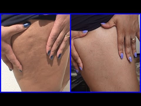 Antes e Depois do Imecap Cellut Resultado após 2 meses de Uso.