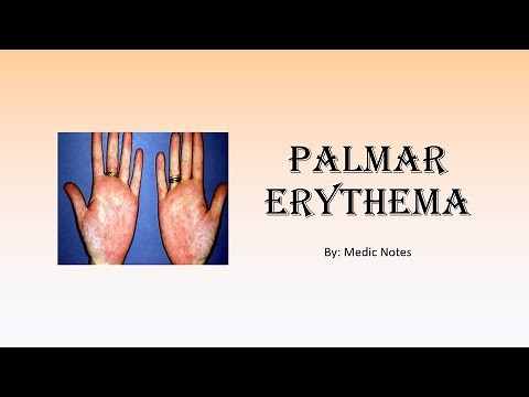 Palmar erythema causes and pathophysiology