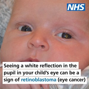 28K views · 129 reactions | Today is Rare Disease Day. Retinoblastoma is a rare type of eye cancer that can affect young children, usually under the age of 5. If it's picked up early, retinoblastoma can often be successfully treated. Read more here: ow.ly/NnnA30qdeea | nhs.uk | Facebook