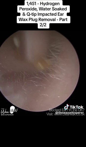 Effective Ear Wax Removal with Hydrogen Peroxide Techniques