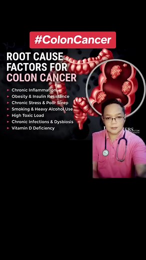 COLON CANCER : Root Cause Factors #coloncancer #chronicinflammation #insulinresistance #obesity #bloodsugar #poorsleep #stress #vitamind #integrativemedicine #doctok #learnontiktok #prevention