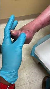 Diabetic patient with a history of amputation of two toes!