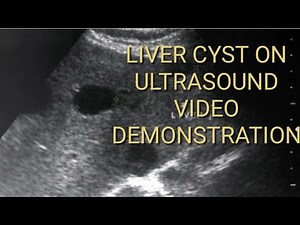 Liver Cyst on ultrasound images. A practical video demonstration for understanding