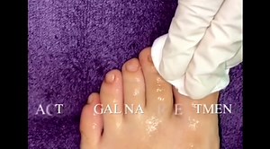 PACT TREATMENT FOR DAMAGED NAILS - FUNGUS NAILS -Get your #nailsready NOW Photodynamic Anti-mycotic (fungal) therapy (PACT) is a new, safe and effective light therapy used to treat fungal nail infections. Fungal organisms that cause fungal nail infections can be effectively eliminated by photodynamic action employing phenothiazinium, porphyrin and phthalocyanine photosensitisers. However, it is safe that it selectively destroys fungi rather than human cells. It is also advisable for use with peo