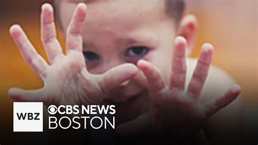 Hand, foot and mouth disease often spreads in the summer. Here's how you can prevent it