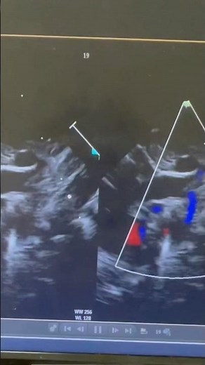 Case #5: Moderate Patent Ductus Arteriosus Identified on Echo