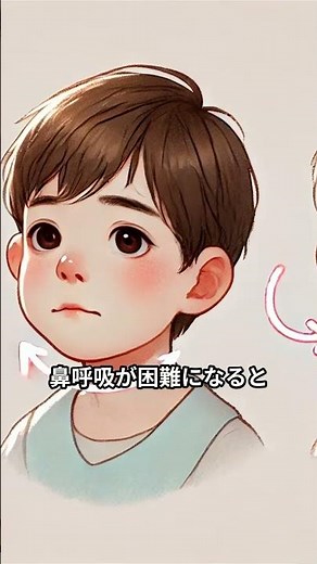 口呼吸が原因？アデノイド顔貌の特徴と治療の選択肢 #口呼吸 #アデノイド顔貌 #矯正