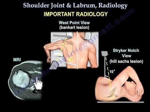 Shoulder Joint & Labrum Radiology - Everything You Need To Know - Dr. Nabil Ebraheim