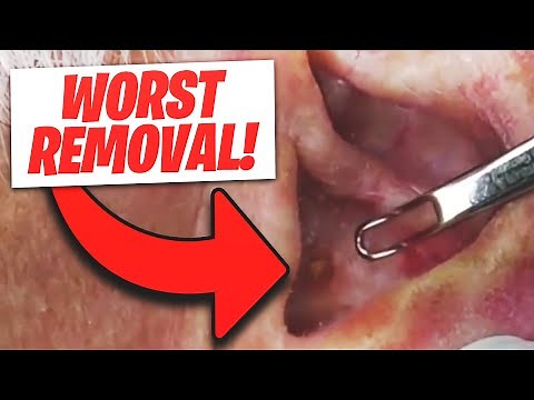 5 WORST Blackhead Removals: SUPER GROSS!