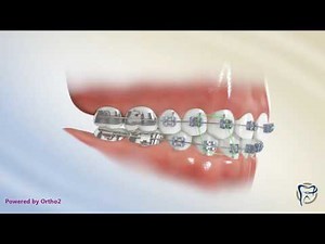 Class III Box Elastics