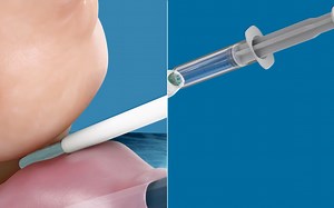 BioProtect的BioProtect球囊植入系统