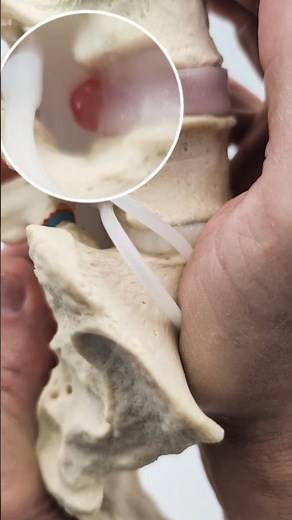 Dynamic L4-Sacrum Model: Disc Pathology & Neurodynamics