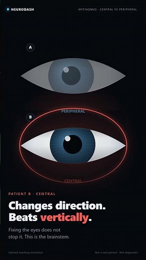 Central vs peripheral nystagmus — spot the stroke in a dizzy patient