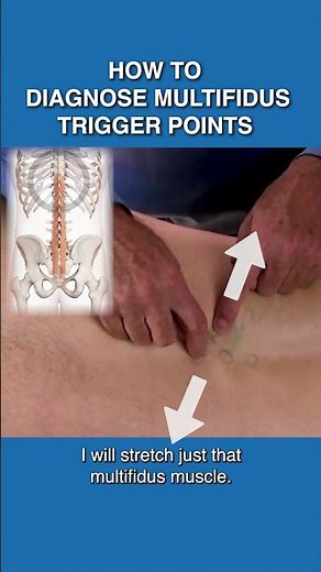 How to diagnose multifiidus Triggers