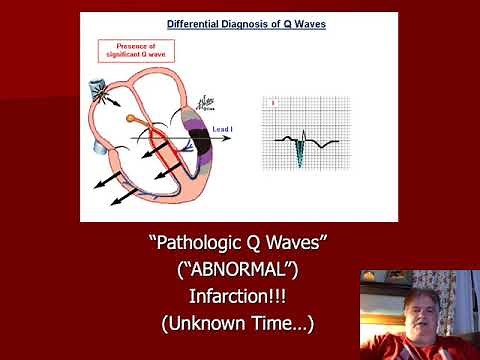 12-Lead EKG Q Waves - Differential Diagnosis