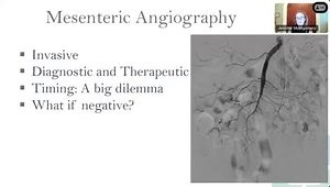 Approach to GI Bleeds from an Interventional Radiology Perspective