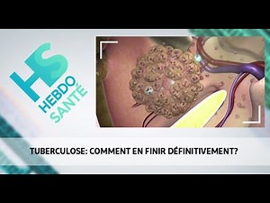 Tuberculose: comment en finir définitivement?