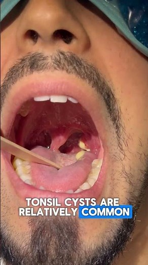Largest tonsil cyst popped!