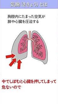 呼吸器内科・佐藤先生の「気胸」1分講座