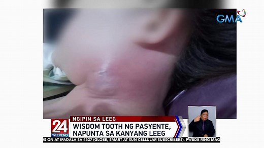 Woman’s neck swells after failed wisdom tooth extraction