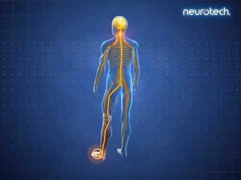Effects of TENS Therapy 1: Pain Gate