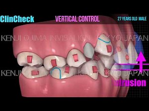 Invisalign Extraction Class II div 2 Deepbite【インビザライン抜歯 過蓋咬合】