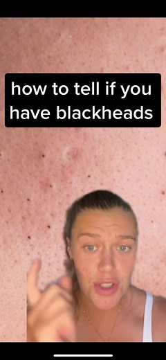 How to Identify and Treat Blackheads on Your Face