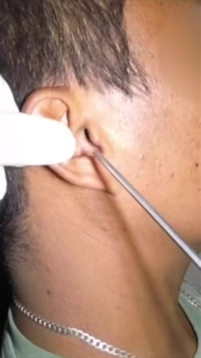 What is it? #earcleaning #earsuction #earforeignbody #earforeignobject #earcare #fyp