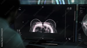 Using medical x-ray equipment for anatomy diagnosis analysis at a hospital. Anatomy x-ray scanner diagnosis system searching for disease. Anatomy x-ray scanner diagnosing cancerous growth in the chest