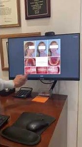 Treating a Deep Overbite Using Invisalign Teen (Before & After)