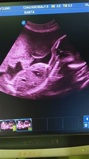 25 weeks baby♥️♥️#baby #ultrasound #pregnancyscan