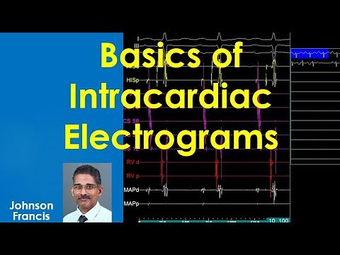 Basics of Intracardiac Electrograms