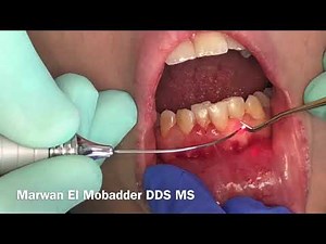 Gingival hyperplasia Treatment with the diode laser 980 nm