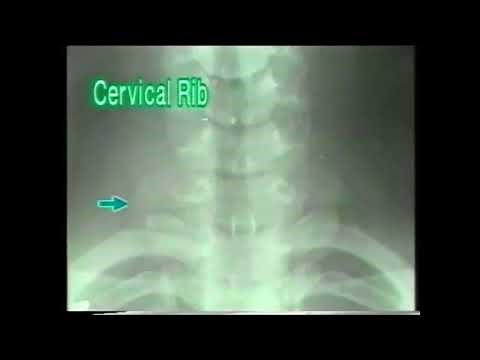 10.2.2. Cervical Rib - X-ray Reading - Dr. Vaidya